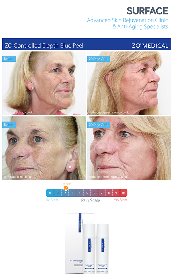 Case Study; ZO Controlled Depth Peel